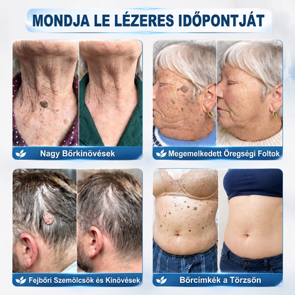 💙Hivatalos Márkabolt | 🚢 Hiskin® 7 napos Szemölcseltávolító Roll-on Ápoló Folyadék (Fájdalommentes rollerball technológia, hegek nélkül) 🐬